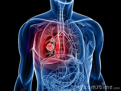 Já é possível fazer prevenção em câncer de pulmão